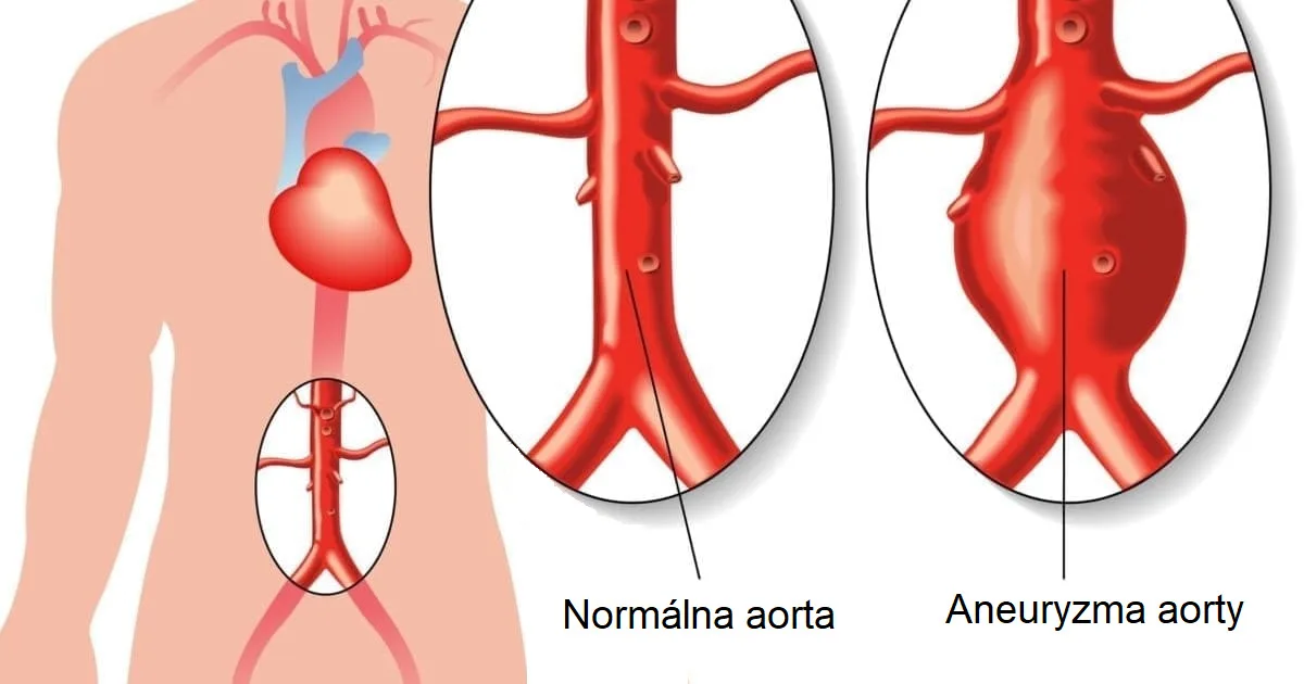 Aneuryzma brušnej aorty